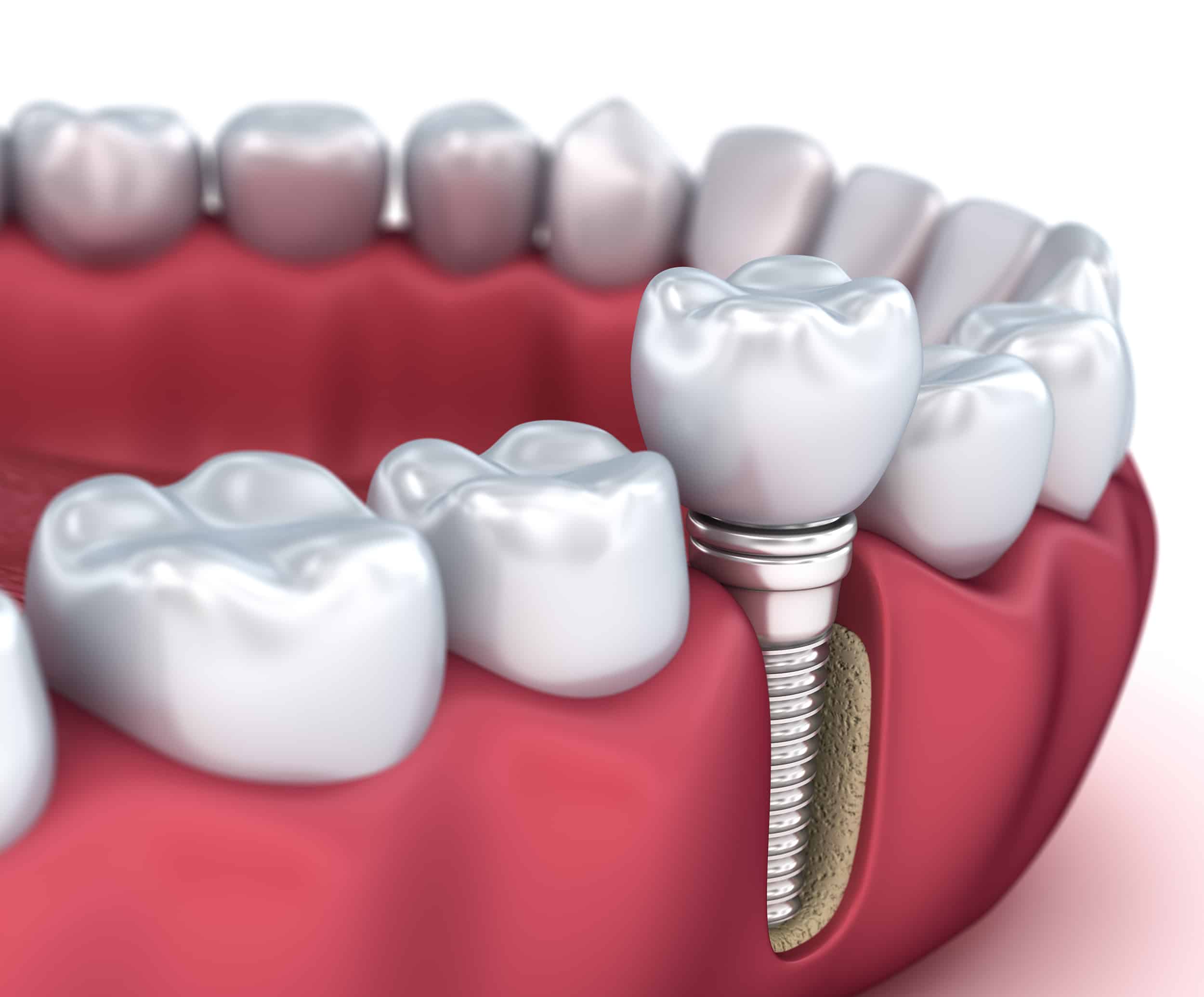 image showing dental implant