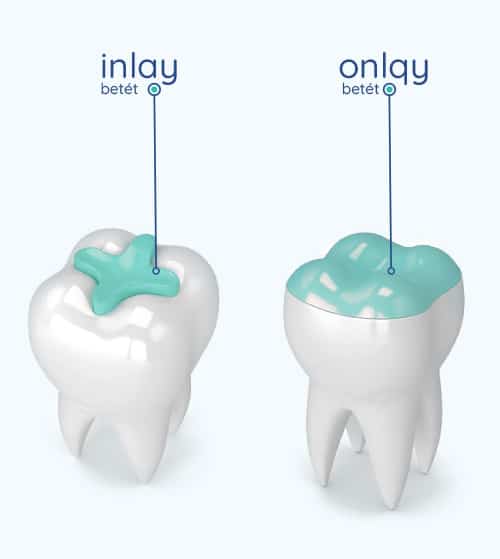 Mik azok a fogászati betétek ( inlay / onlay)?