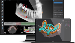 3D navigált fogpótlás Buda Dental-18 éves kortól cikk