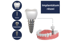 Implantátum részei Buda Dental- 18 éves kortól cikk