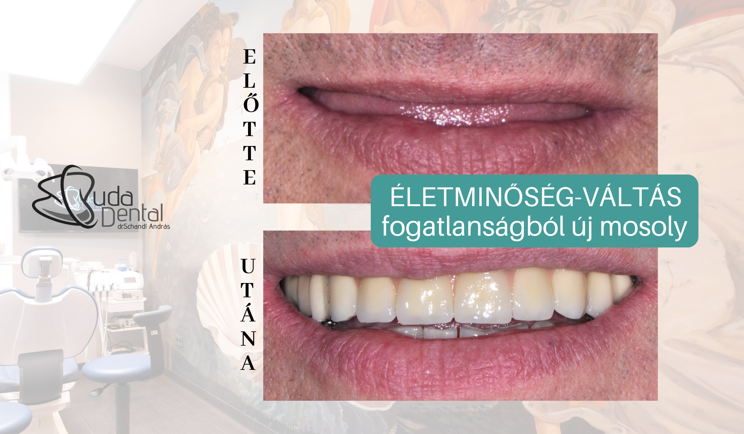 1 Implant vélemény
