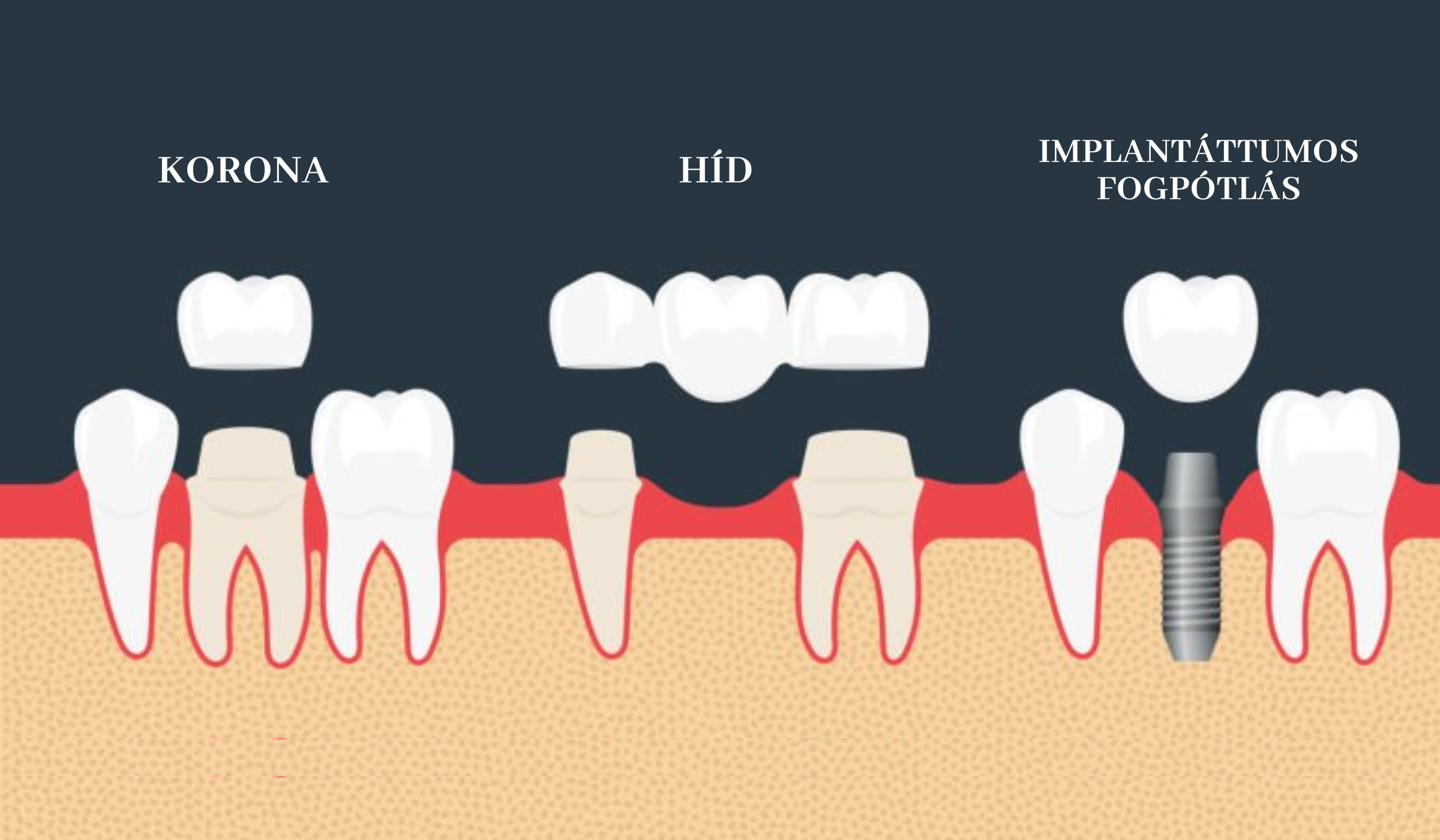 Buda Dental blog képek Implant vélemény